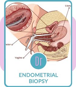 Endometrial Biopsy - Dr Richard Beyerlein MD in Eugene, OR