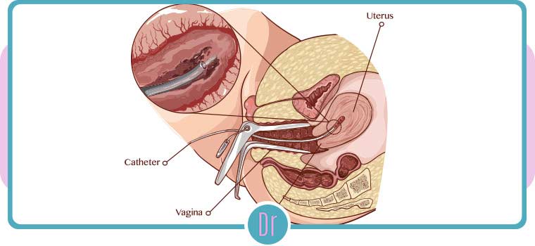 Endometrial Biopsy of the Uterus Near Me in Eugene OR Endometrial Biopsy of the Uterus Near Me in Eugene OR