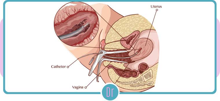 Endometrial Biopsy of the Uterus Near Me in Eugene OR